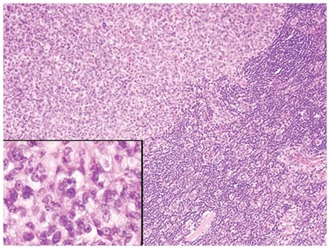 metastatic malignant melanoma in lymph nodes